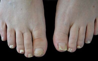 Comment se débarrasser du champignon sur leurs doigts