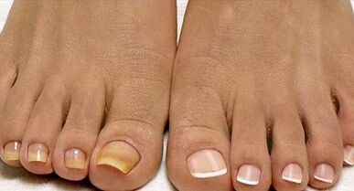 Méthodes de traitement des champignons de la flotte