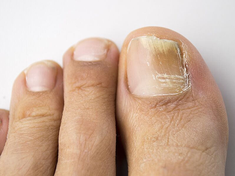 La phase initiale du champignon