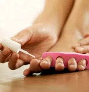 Application du vernis thérapeutique