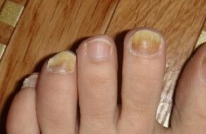 Jaunissement de l'ongle dû à un champignon