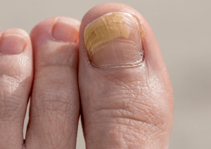 champignon sur l'ongle du gros orteil